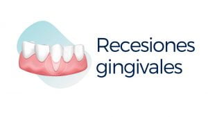 recesiones gingivales